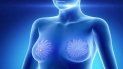 como prevenir el cancer de mama como prevenir el cancer de mama
