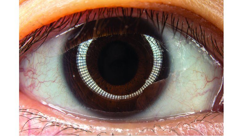 infección ocular en tejido profundo infección ocular en tejido profundo