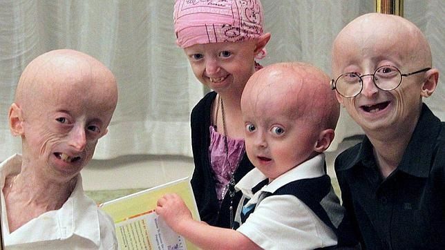 Progeria: el drama de los niÃ±os viejos | Ciencia