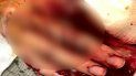 La víctima fue trasladada a urgencias de un hospital en Hollywood para ser operada. La víctima fue trasladada a urgencias de un hospital en Hollywood para ser operada.