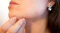 Hay casos en los que el folículo se abre y libera bacterias dentro de la piel, que se infecta creando pápulas, pústulas o, en situaciones extremas, nódulos. Hay casos en los que el folículo se abre y libera bacterias dentro de la piel, que se infecta creando pápulas, pústulas o, en situaciones extremas, nódulos.