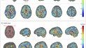 Foto de diversas tomografías cerebrales de funcionarios estadounidenses que estaban en Cuba, comparadas con las de un grupo de control, en una foto suministrada por la Asociación Médica de EEUU en julio del 2019. Foto de diversas tomografías cerebrales de funcionarios estadounidenses que estaban en Cuba, comparadas con las de un grupo de control, en una foto suministrada por la Asociación Médica de EEUU en julio del 2019.