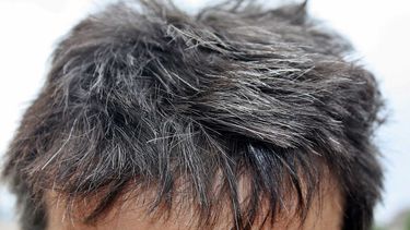 Las canas desaparecen tras un tratamiento para el cáncer de pulmón
