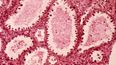 Un adenocarcinoma de células claras compuesto por tubos revestidos por células hobnail. (Foto Wikimedia) 