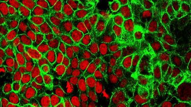 Imagen de microscopio difundida por el Centro de Investigación sobre el Cáncer muestra células de cáncer de colon humano con los núcleos teñidos de rojo.&nbsp;