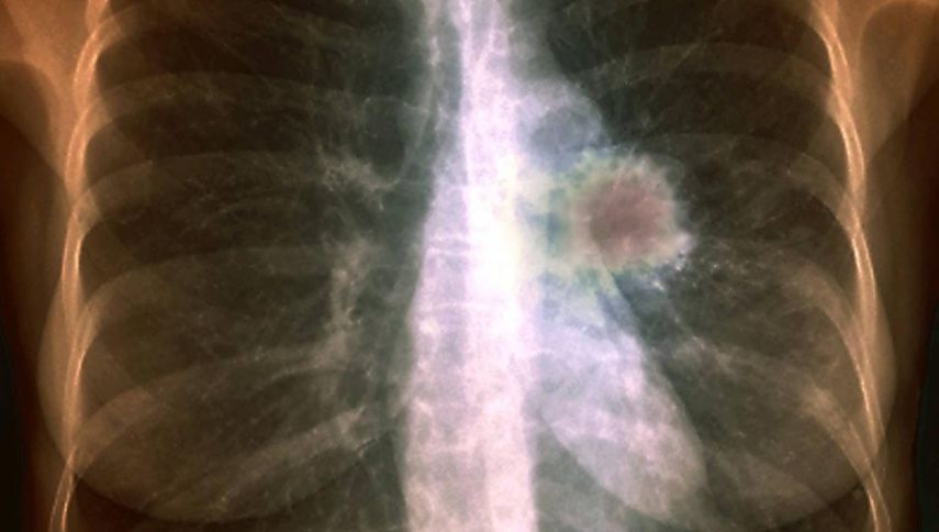 La detección de cáncer de pulmón en una fase temprana no es habitual. Normalmente, los síntomas aparecen cuando ya es demasiado tarde para vencer al cáncer.