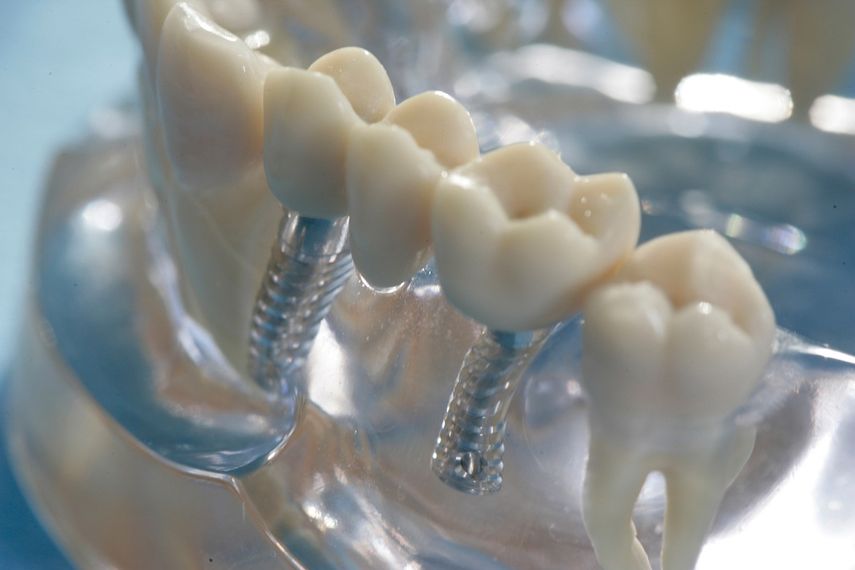 El implante es una raíz artificial para colocar dientes.