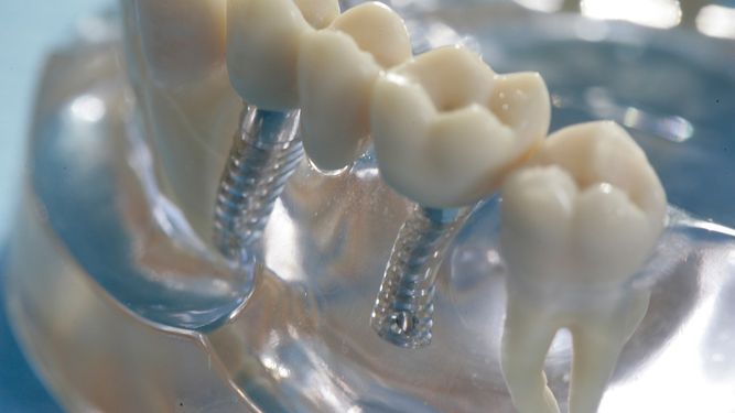 El implante es una raíz artificial para colocar dientes.