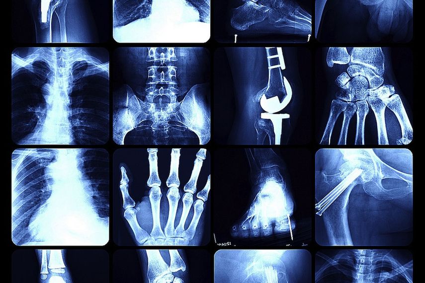 Se estima que una de cada tres mujeres y uno de cada 12 hombres, de más de 50 años, sufren de osteoporosis. (Archivo)