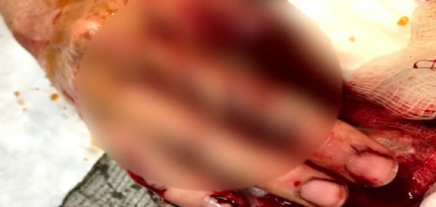 La víctima fue&nbsp;trasladada a urgencias de un hospital en Hollywood para ser operada.