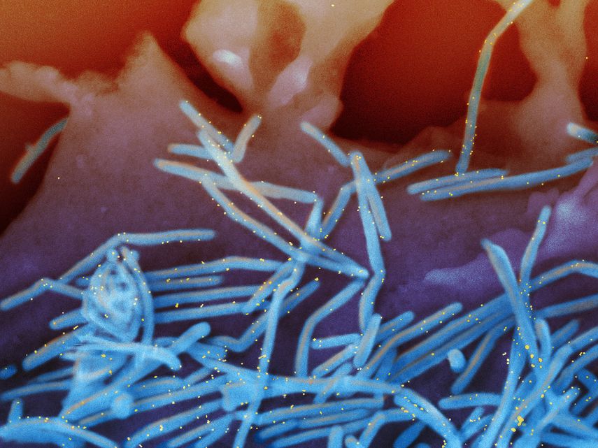 Esta imagen de microscopio electrónico provista por los Institutos Nacionales de Salud muestra viriones del virus respiratorio sincicial humano, coloreados de azul, y anticuerpos proteicos anti-VRS, coloreados de amarillo, derramándose de la superficie de células pulmonares humanas.
