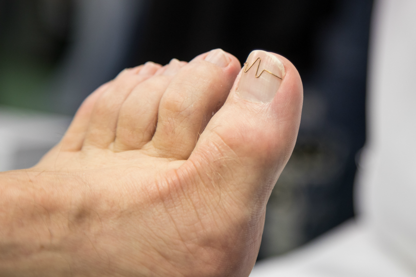 Cuando la uña crece mal, se puede tratar de enderezar su forma con pinzas.&nbsp;