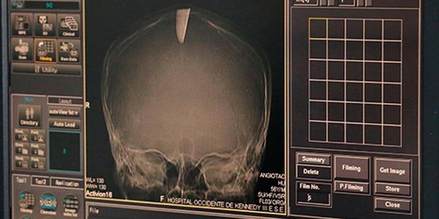 Imagen tomada por los médicos donde se ve el cuchillo en el interior del cráneo.&nbsp;