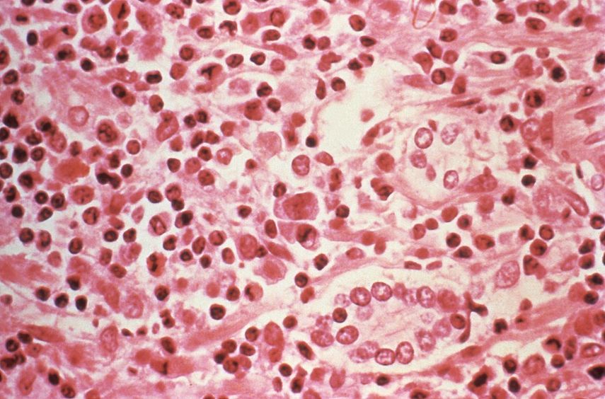 Fotografía tomada a través de un microscopio de una muestra de tejido hepático que fue extraída de un paciente con síndrome pulmonar por hantavirus (HPS).