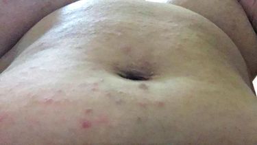 Un brote de sarna afecta a la poblaci&oacute;n cubana.