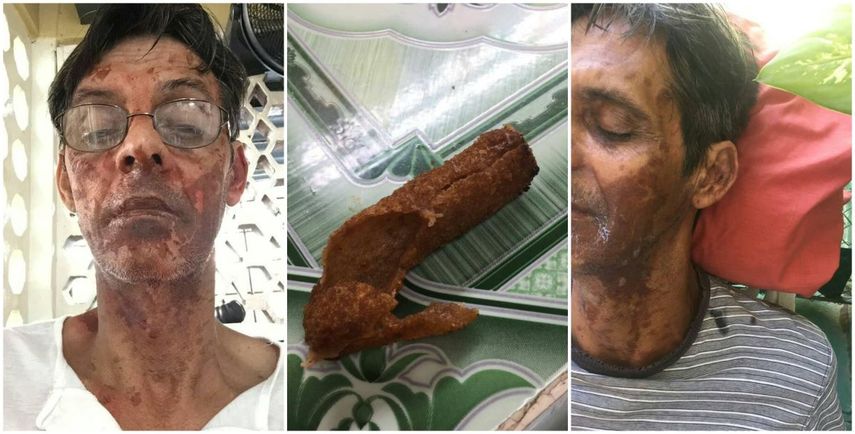 Continúan apareciendo casos en la isla de serias lesiones por las llamadas croquetas dinamita que estallan en el momento de cocinarlas o después, de forma sorpresiva