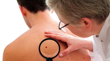 En algunos casos, los nevos o lunares se relacionan directamente con el cáncer de piel. (Archivo)