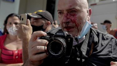 El fotógrafo de AP, el español Ramón Espinosa, aparece con heridas en la cara mientras cubría una manifestación contra el dictador cubano Miguel Díaz-Canel en La Habana, el 11 de julio de 2021.