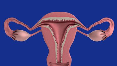 La OMS ha documentado que el síndrome de ovario poliquístico es una de las principales causas de menstruación irregular y una de las causas más comunes de infertilidad