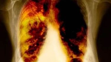 El cáncer de pulmón siempre es tratable, sin importar el tamaño, la localización, si se ha diseminado y cuánto se ha extendido. (Archivo)