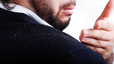 Afortunadamente, la caspa es inofensiva y casi siempre se puede controlar con productos que no requieren prescripción médica.(Archivo)