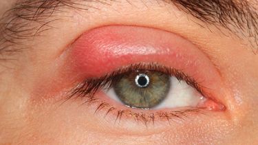 Si el orzuelo dura más de dos meses y no se cura solo también hay que consultar con el médico, que puede ayudar a eliminarlo abriéndolo con un escalpelo.