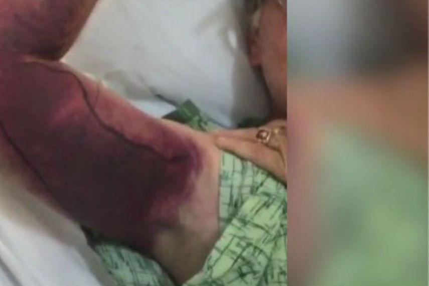 Efectos de la picada de la serpiente (CORTESÍA)