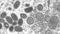 Esta imagen de un microscopio electrónico, proporcionada por los Centros para el Control y la Prevención de Enfermedades (CDC, por sus siglas en inglés) de Estados Unidos, muestra viriones maduros de viruela símica, de forma ovalada (izquierda) y viriones inmaduros esféricos (derecha), obtenidos de una muestra de piel humana vinculada con un brote de 2003. Esta imagen de un microscopio electrónico, proporcionada por los Centros para el Control y la Prevención de Enfermedades (CDC, por sus siglas en inglés) de Estados Unidos, muestra viriones maduros de viruela símica, de forma ovalada (izquierda) y viriones inmaduros esféricos (derecha), obtenidos de una muestra de piel humana vinculada con un brote de 2003.