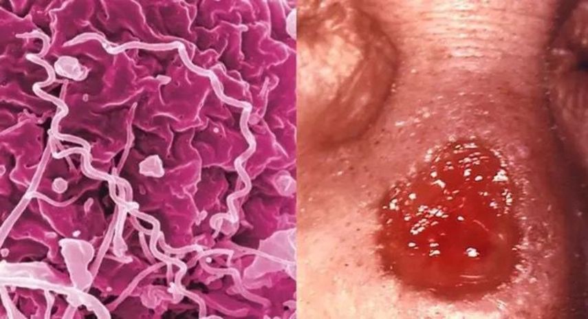 Treponema pallidum, bacteria de la sífilis.