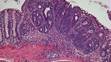 Tumor de colon.&nbsp;
