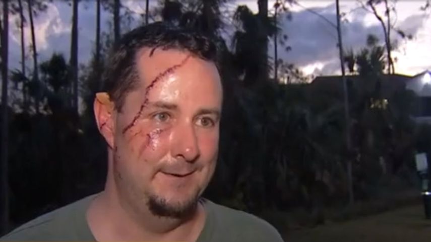 Andrew Meunier recibió 41 puntos de sutura en el rostro como consecuencia del ataque de un oso negro frente a su casa en Naples.&nbsp;