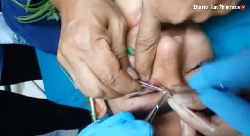 Un equipo de médicos del Instituto Nacional de Salud del Niño (INSN) de Lima extrajo con hojas de albahaca una larva de mosca de oveja de tres centímetros de longitud, alojada durante casi un mes en el ojo de un adolescente, informó a Efe la oftalmólog