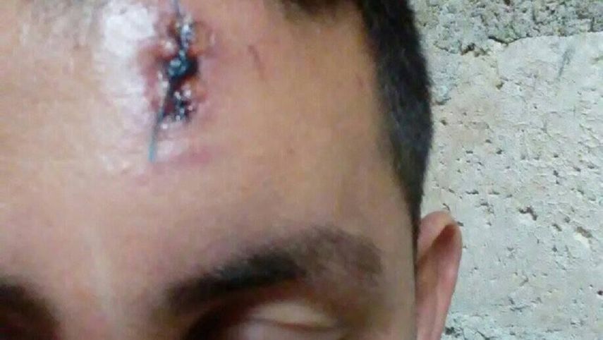 Balsero con balazo de goma en la frente: pudo ser peor