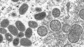 Esta imagen de un microscopio electrónico, proporcionada por los Centros para el Control y la Prevención de Enfermedades (CDC, por sus siglas en inglés) de Estados Unidos, muestra viriones maduros de viruela símica, de forma ovalada (izquierda) y viriones inmaduros esféricos (derecha), obtenidos de una muestra de piel humana vinculada con un brote de 2003.