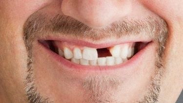 La carencia de piezas dentales afecta la calidad de vida de las personas tanto física como emocionalmente. (Archivo)