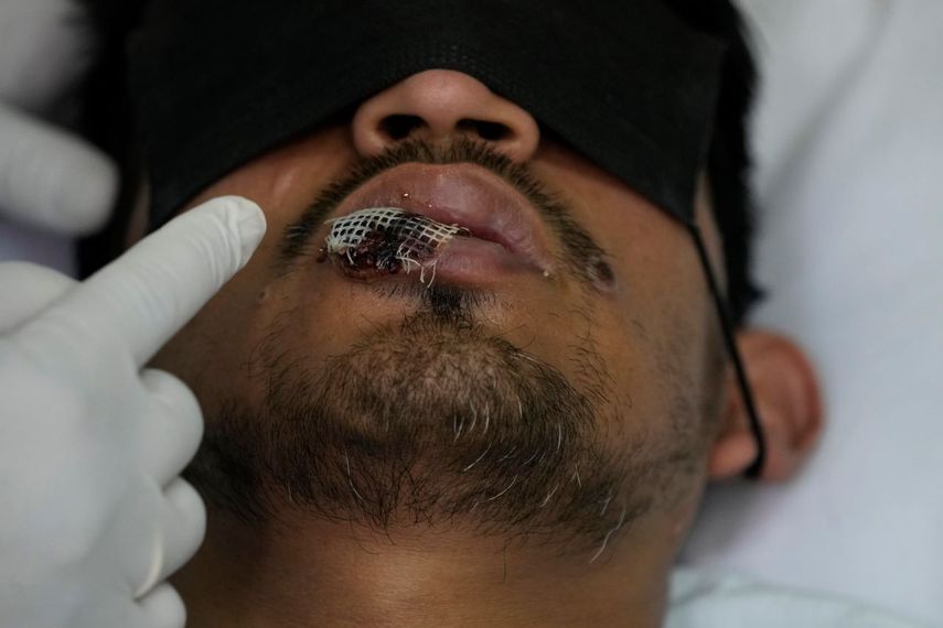 Un médico muestra una llaga de viruela del simio en el labio de un paciente, en el hospital Arzobispo Loayza en Lima, Perú.  Un médico muestra una llaga de viruela del simio en el labio de un paciente, en el hospital Arzobispo Loayza en Lima, Perú.