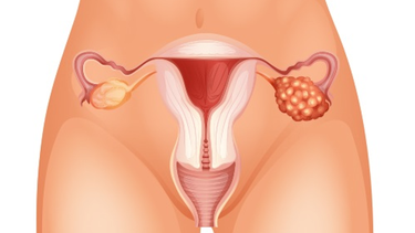 cuatro sintomas tempranos de cancer de ovario