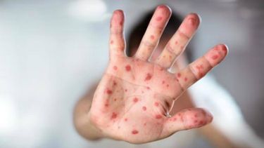 De los 822 casos confirmados, 519 fueron registrados en el estado de Amazonas y 272 en el de Roraima, así como algunos casos aislados en los estados de Sao Paulo (1), Río de Janeiro (14), Río Grande do Sul (13), Rondônia (1) y Para (2).