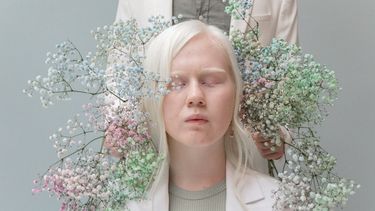 El 13 de junio es el Día Internacional de Sensibilización sobre el Albinismo