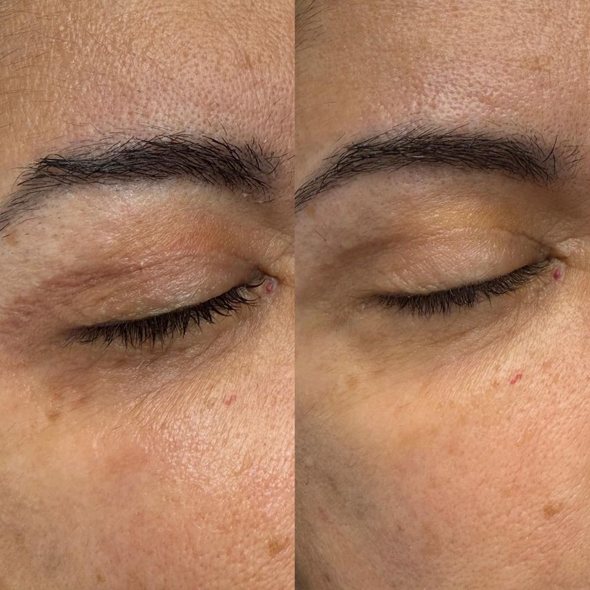 Antes y después del tratamiento con láser CO2.