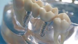 El implante es una raíz artificial para colocar dientes.