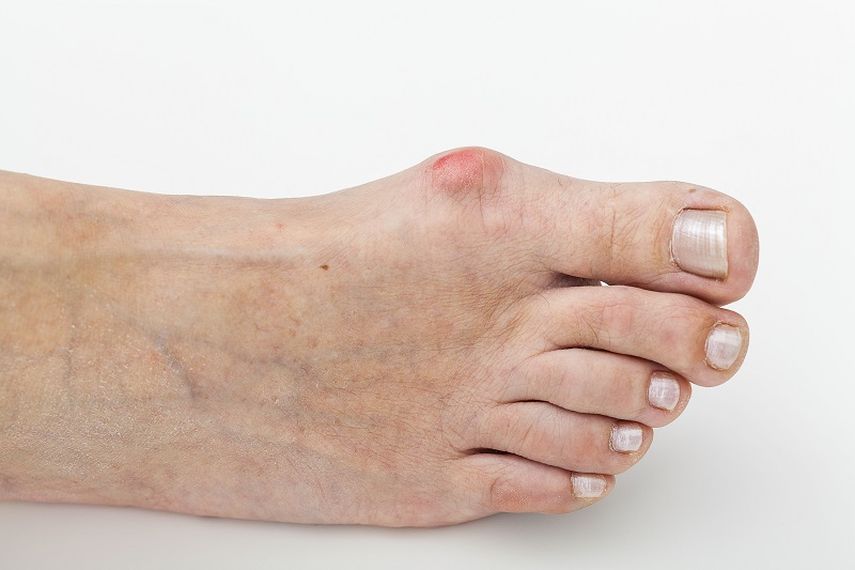 El hallux valgus, es una enfermedad que produce dolor e inflamación, dificultades para calzarse, y por supuesto, problemas estéticos. (Archivo)