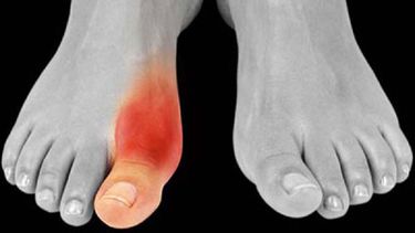 Los ataques de gota suelen ser una respuesta a situaciones estresantes o consecuencia del consumo excesivo de  alcohol. (Archivo)