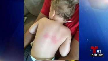 La madre desvistió al pequeó para mostrar los morotones que tenía en la espalda