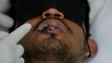 &nbsp;Un médico muestra una llaga de viruela del simio en el labio de un paciente, en el hospital Arzobispo Loayza en Lima, Perú.