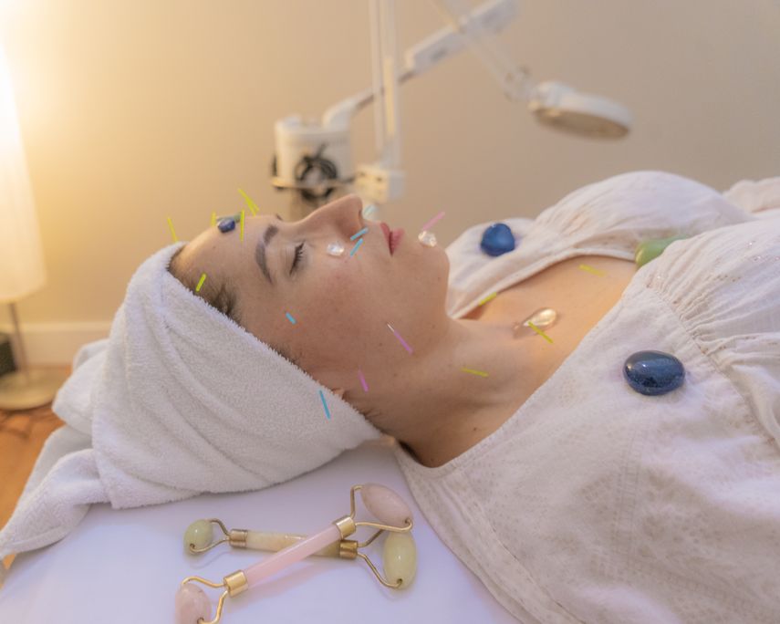 Tratamiento de belleza&nbsp;a base de acupuntura, que practican en el centro Benessere, ubicado en Doral, Florida.