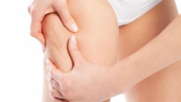 La celulitis es más que un  simple problema estético. (Archivo)