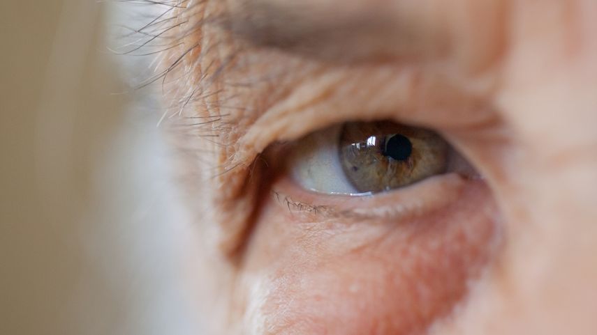 El Glaucoma afecta a más de un 3% de la población.