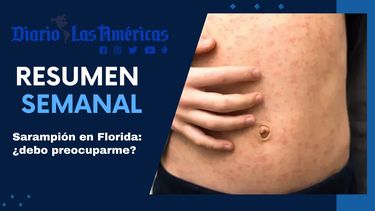 sarampion en florida: ¿debo preocuparme?