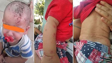 Niños en Cuba afectados por la sarna.&nbsp;